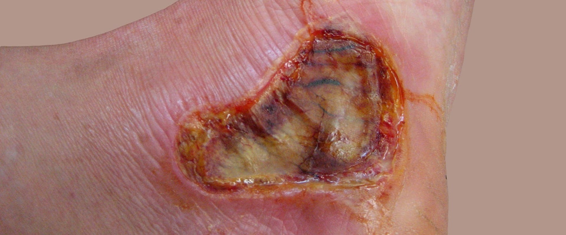 The Healing Power of Third-Degree Burns