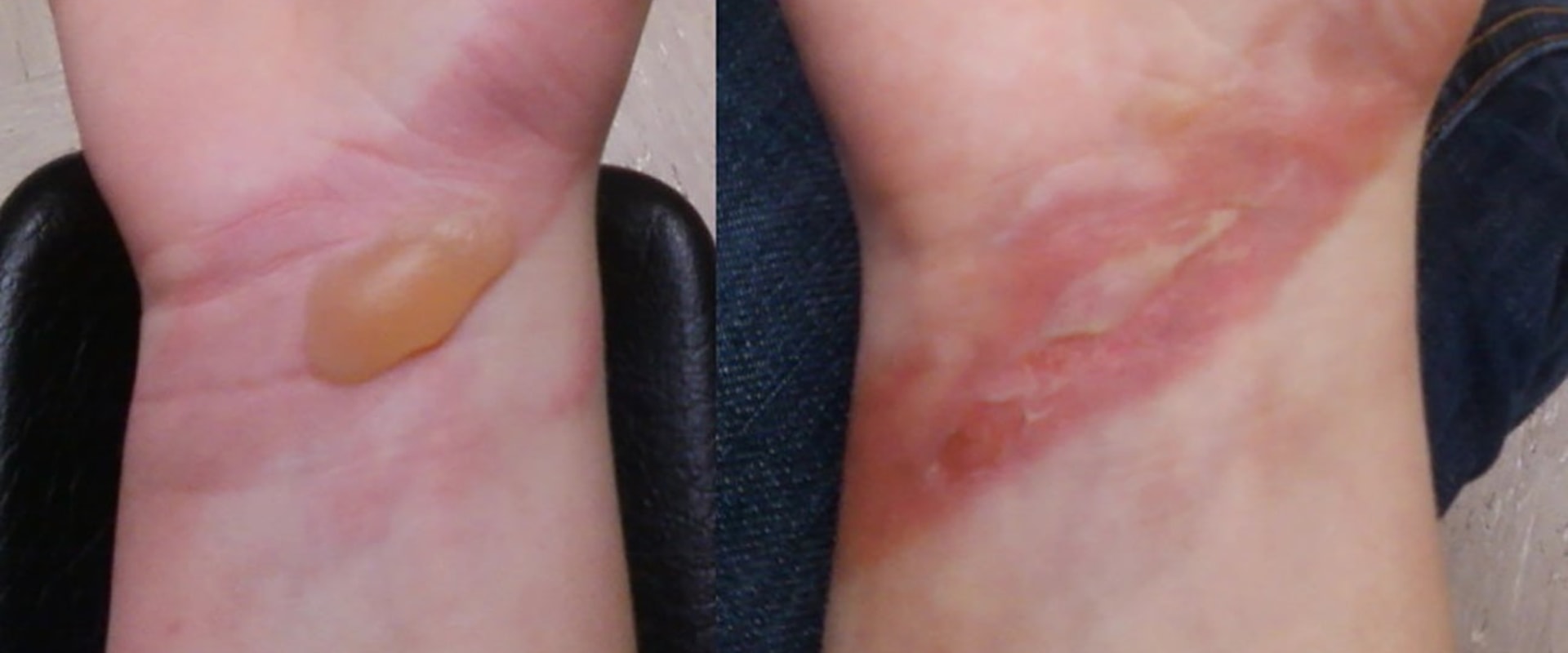 Burn Degree Chart Explained: How to Spot and Treat Burn Types