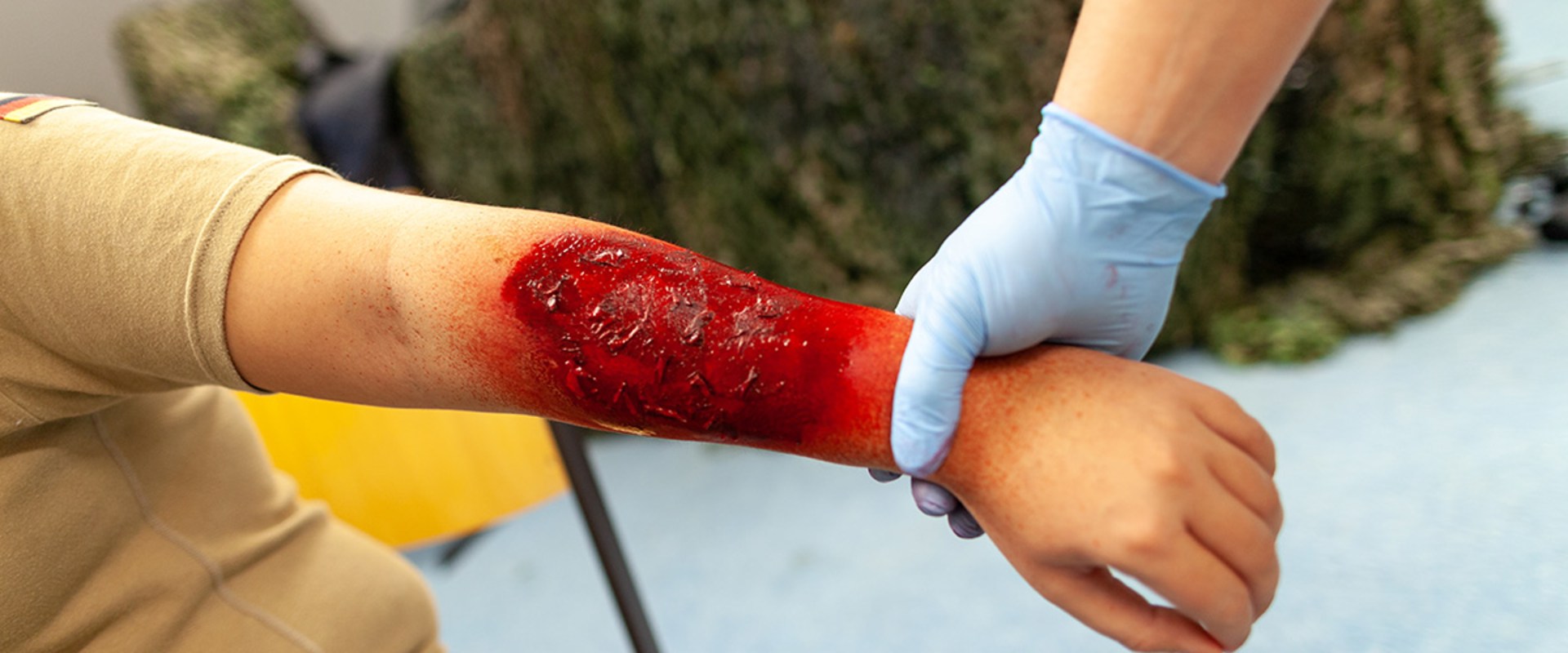 From Mild to Severe: Burn Degree Chart With Care Tips & Warnings