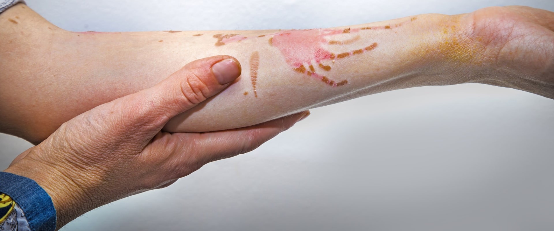 1st vs 2nd vs 3rd Degree Burns: What’s the Difference and Why It Matters for Treatment