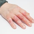 Understanding Second-Degree Burns: Symptoms, Treatment, and Healing Process