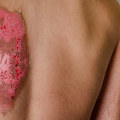 The Healing Power of Nutrition for Severe Burns