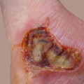 The Devastating Effects of Third-Degree Burns: What You Need to Know