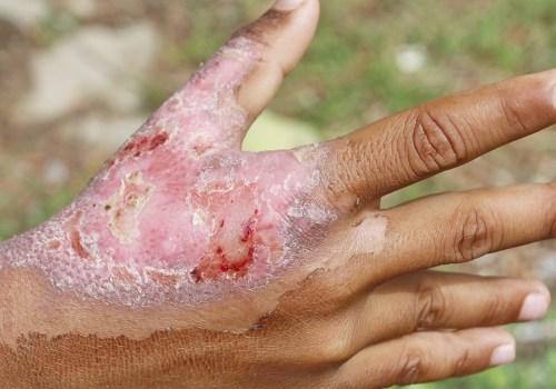 Understanding the Different Degrees of Burns