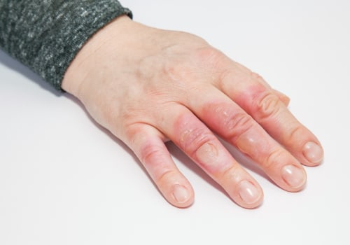 The Importance of Proper Care for Second-Degree Burns: An Expert's Perspective