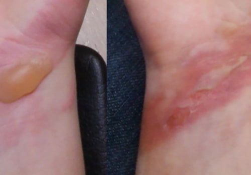 Burn Degree Chart Explained: How to Spot and Treat Burn Types