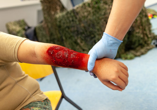 From Mild to Severe: Burn Degree Chart With Care Tips & Warnings