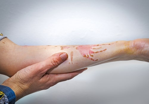 1st vs 2nd vs 3rd Degree Burns: What’s the Difference and Why It Matters for Treatment